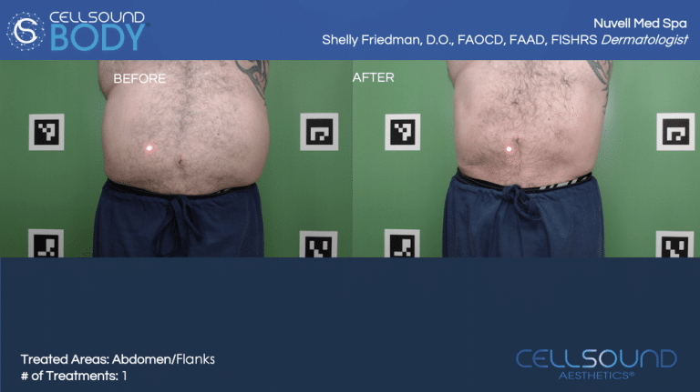 CellSound Abdomen Before and After 2
