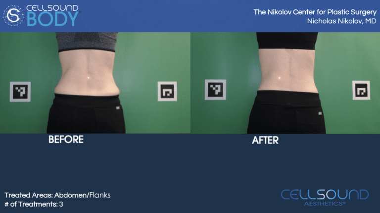 CellSound Abdomen Before and After 8