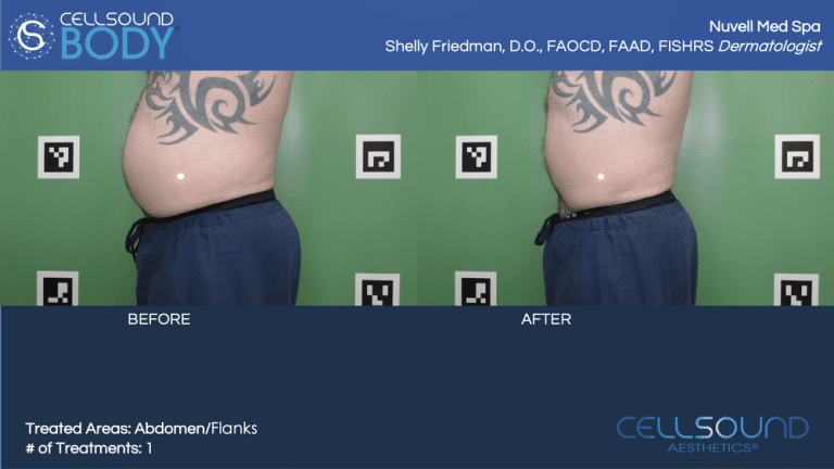 CellSound Abdomen Before and After 9