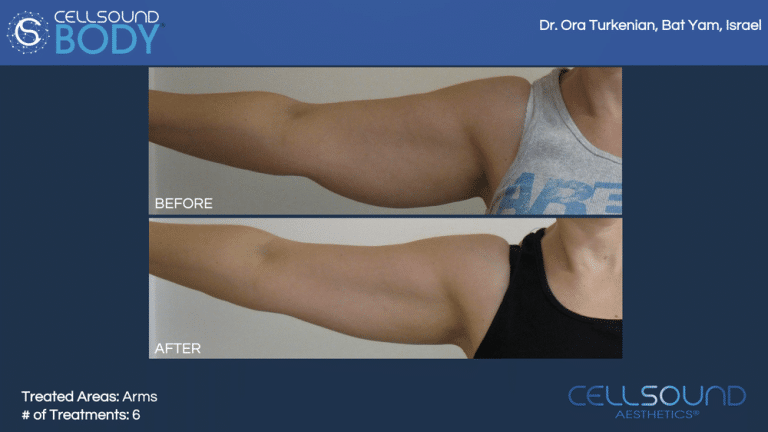 CellSound Arms Before and After