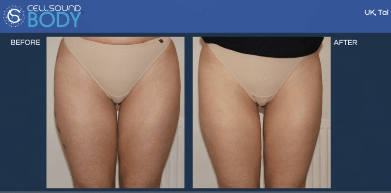 CellSound Thighs Before and After