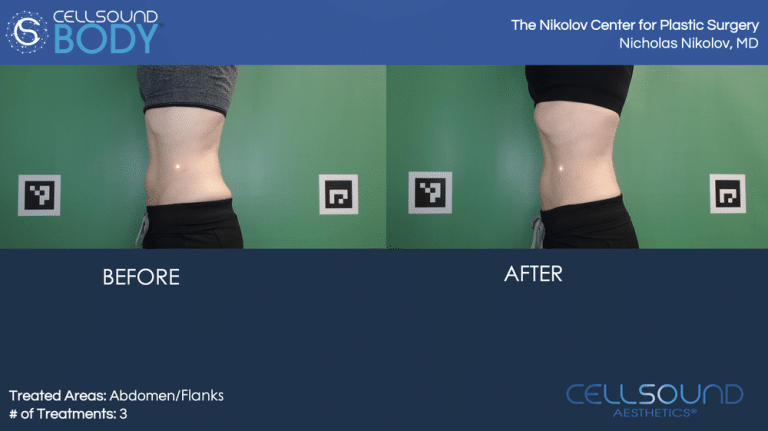 Cellsound Abdomen Before and After 11