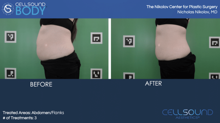 Cellsound Abdomen Before and After 4