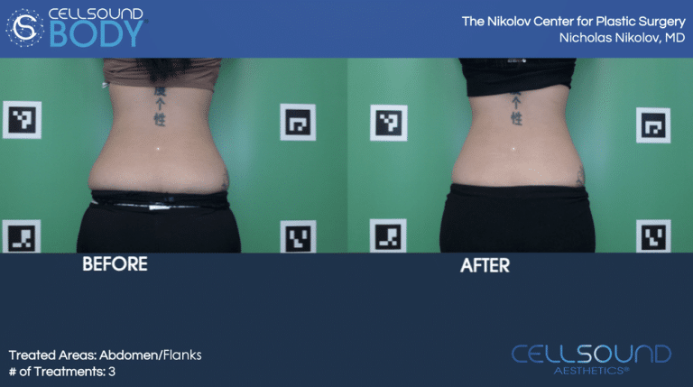 Cellsound Abdomen Before and After 5