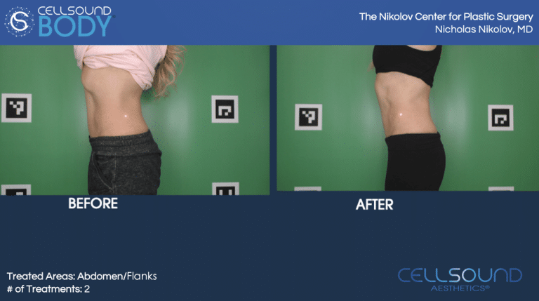 Cellsound Abdomen Before and After 6