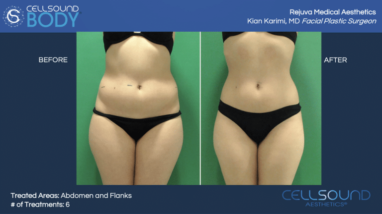 Cellsound Abdomen Before and After