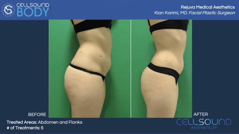 Cellsound Abdomen Before and After Female