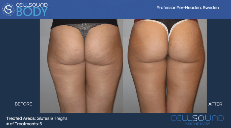 Cellsound Buttocks Before and After 2