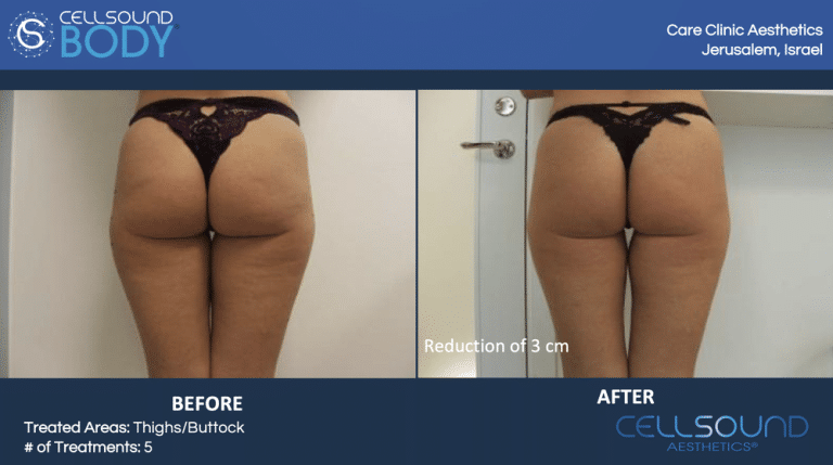 Cellsound Buttocks Before and After