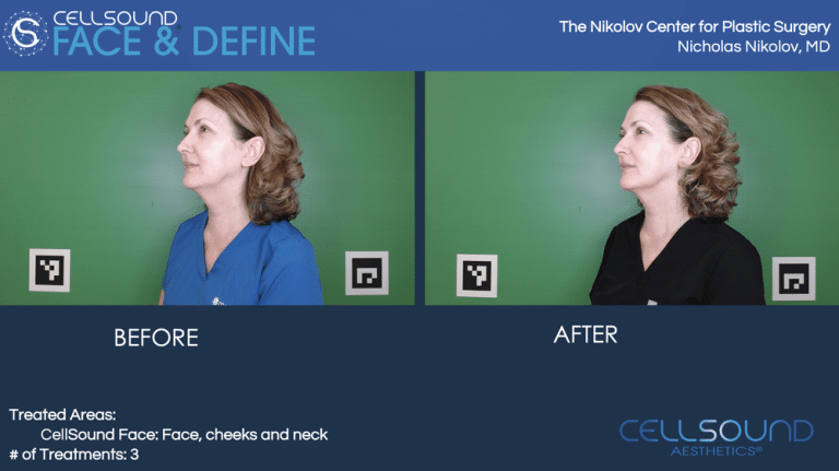 Cellsound Face and Neck