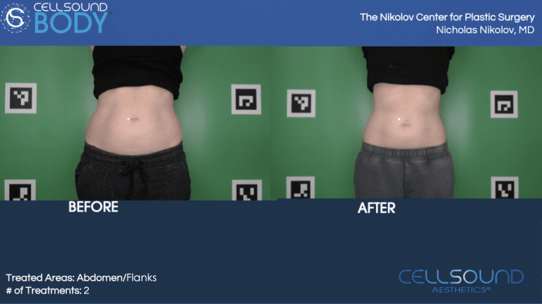 Cellsound abdomen Before and After 7